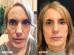 Liquid Facelift Before and After
