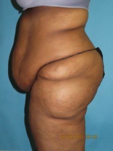 Tummy Tuck Before Photo by Dr. Sean Lille in Scottsdale, AZ