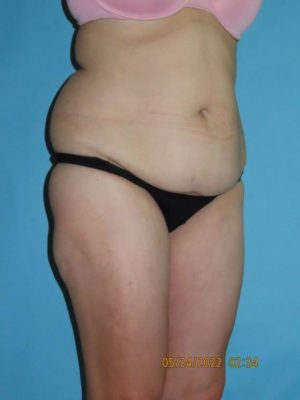 Liposuction