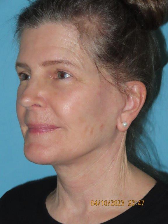 Facelift