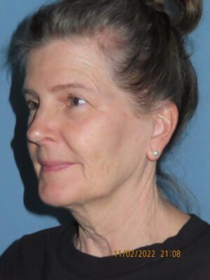 Facelift