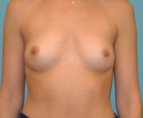 Breast Augmentation