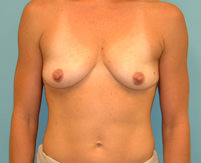 Breast Augmentation