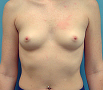 Breast Augmentation