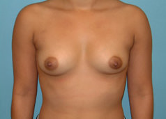 Breast Augmentation