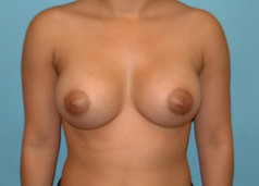 Breast Augmentation