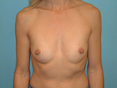 Breast Augmentation