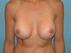 Breast Augmentation