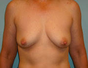 Breast Augmentation