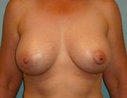 Breast Augmentation