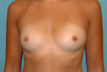 Breast Augmentation