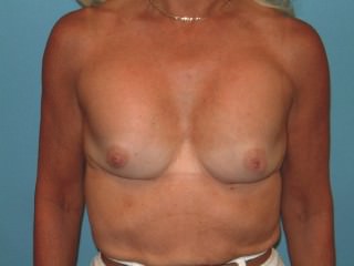 Breast Revision