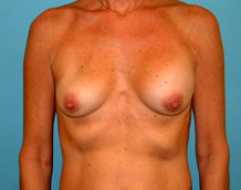 Breast Revision