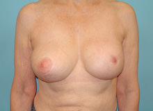 Breast Revision