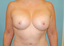 Breast Revision