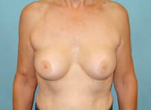 Breast Revision