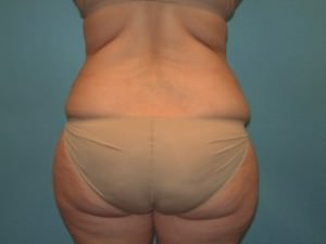 Liposuction