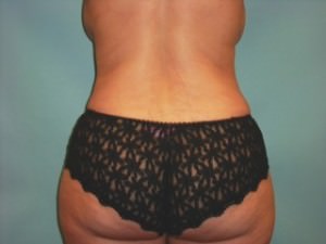 Liposuction