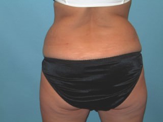 Liposuction