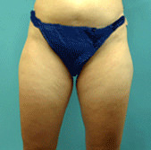 Liposuction