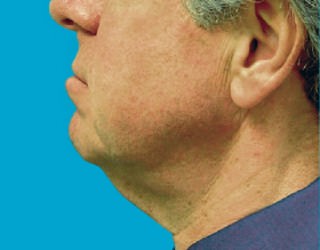 Neck Lift: Men
