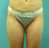 Liposuction