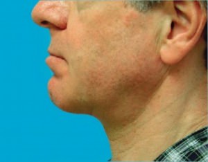 Neck Lift: Men