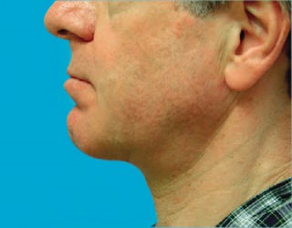 Neck Lift: Men
