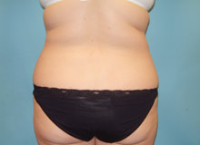 Liposuction