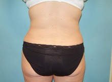 Liposuction