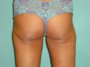 Liposuction