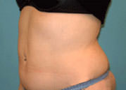 Liposuction