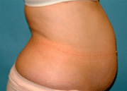 Liposuction