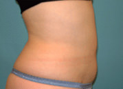 Liposuction