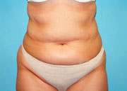 Liposuction