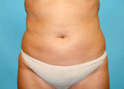 Liposuction