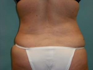 Liposuction