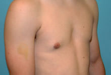 Male Breast Reduction - Gynecomastia