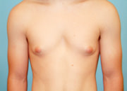 Male Breast Reduction - Gynecomastia