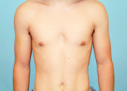 Male Breast Reduction - Gynecomastia