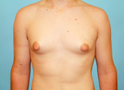 Male Breast Reduction - Gynecomastia