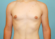 Male Breast Reduction - Gynecomastia