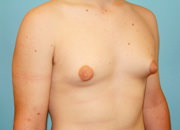 Male Breast Reduction - Gynecomastia