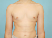 Male Breast Reduction - Gynecomastia