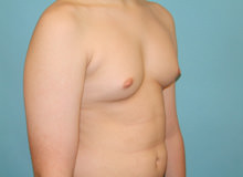 Male Breast Reduction - Gynecomastia