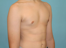 Male Breast Reduction - Gynecomastia