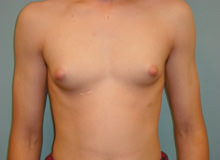 Male Breast Reduction - Gynecomastia