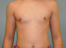 Male Breast Reduction - Gynecomastia