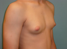 Male Breast Reduction - Gynecomastia