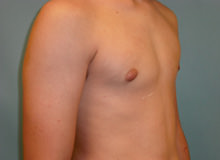 Male Breast Reduction - Gynecomastia